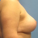 Breast Augmentation & Lift After Patient Thumbnail 3