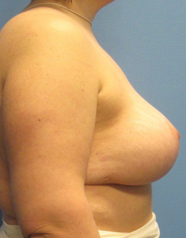Breast Augmentation & Lift After Patient 3