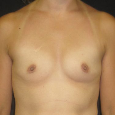 Breast Augmentation Before Patient 20