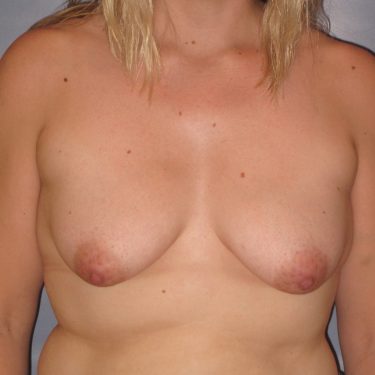Breast Lift Before Patient 13