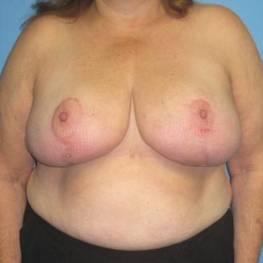Breast Reduction After Patient 8