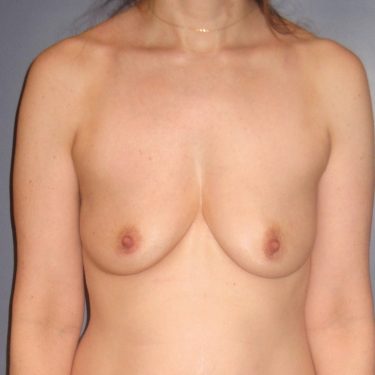 Pectus deformity Before Patient 4