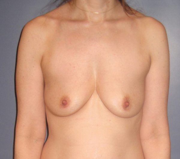Breast Augmentation Before Patient 1