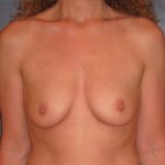 Breast Augmentation Before Patient Thumbnail 1