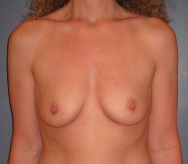 Breast Augmentation Before Patient 1