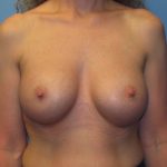 Breast Augmentation After Patient Thumbnail 1
