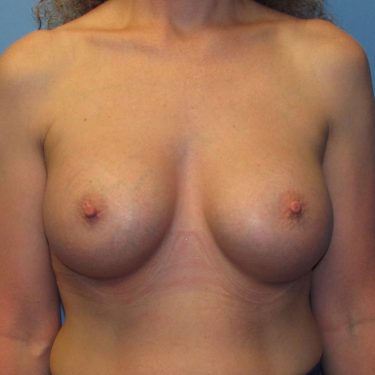 Breast Augmentation After Patient 17