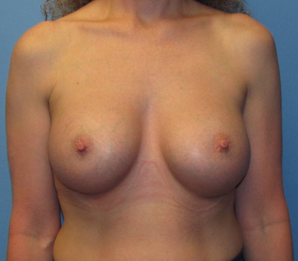 Breast Augmentation After Patient 1