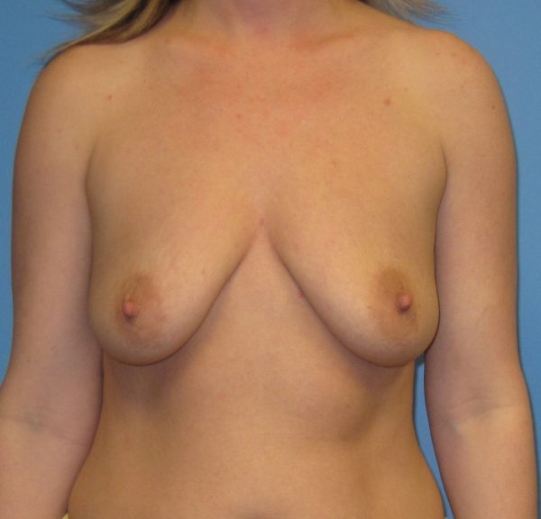 Breast Augmentation Before Patient 1