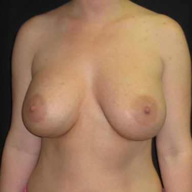 Dual-plane technique After Patient 8