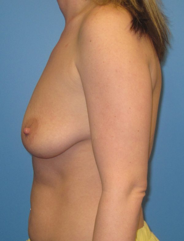 Breast Augmentation Before Patient 3