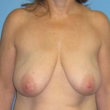 Breast Lift Before Patient 21