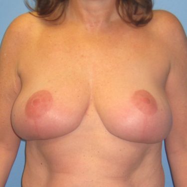 Breast Lift After Patient 21