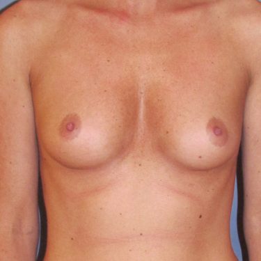 Breast Augmentation Before Patient 15