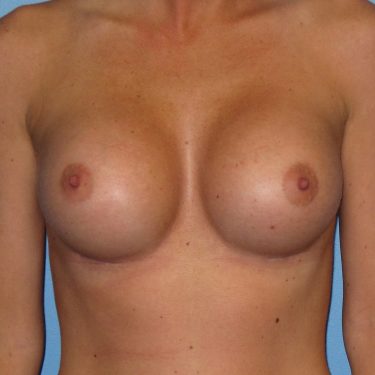 Breast Augmentation After Patient 15