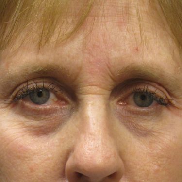 Eyes & Brow Before Patient 5