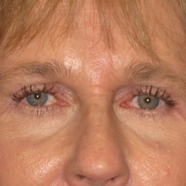 Eyes & Brow After Patient 5
