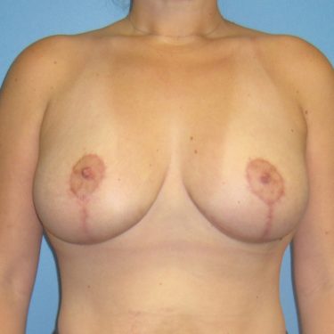 Breast Lift After Patient 12