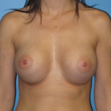 Breast Augmentation After Patient 14
