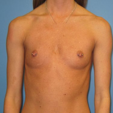 Breast Augmentation Before Patient 13