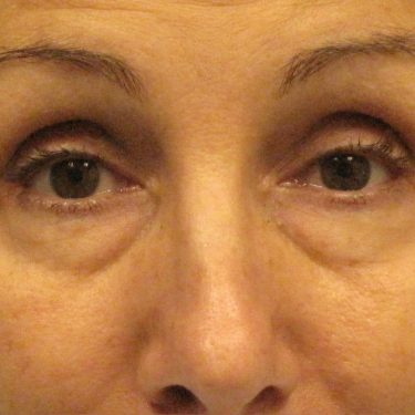 Eyes & Brow Before Patient 4