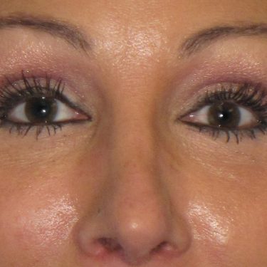 Eyes & Brow After Patient 4