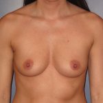Breast Augmentation Before Patient Thumbnail 1