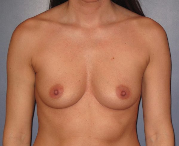 Breast Augmentation Before Patient 1