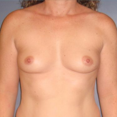 Breast Augmentation Before Patient 10