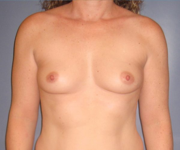Breast Augmentation Before Patient 1