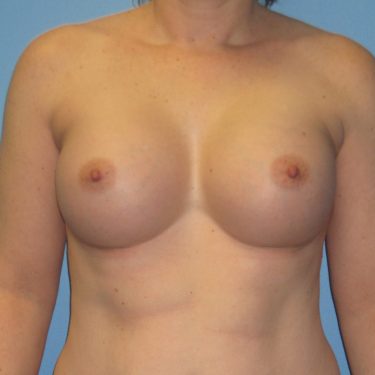Breast Augmentation After Patient 10
