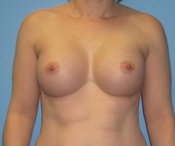 Breast Augmentation After Patient 1
