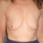 Breast Augmentation Before Patient Thumbnail 1