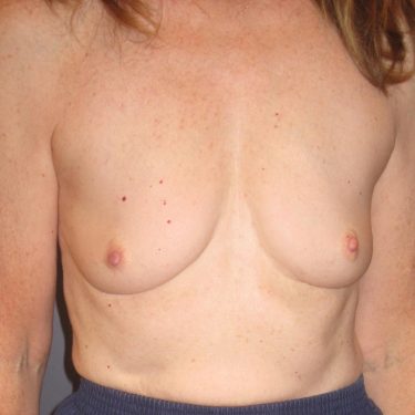 Breast Augmentation Before Patient 9