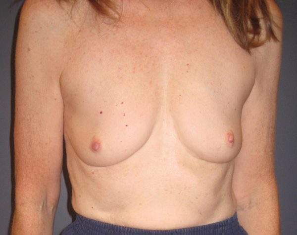 Breast Augmentation Before Patient 1