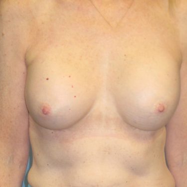 Breast Augmentation After Patient 9