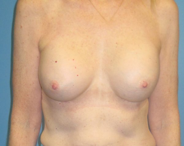 Breast Augmentation After Patient 1