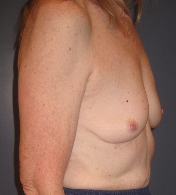 Breast Augmentation Before Patient 2