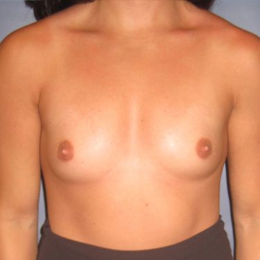 Breast Augmentation Before Patient 8