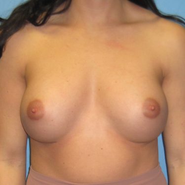 Breast Augmentation After Patient 8