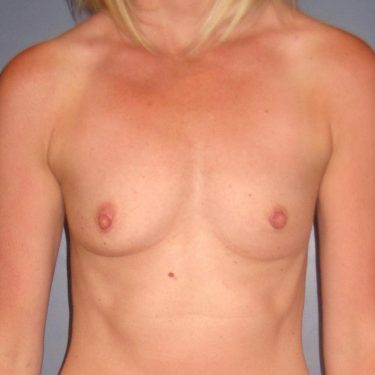 Breast Augmentation Before Patient 1