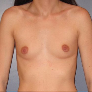 Breast Augmentation Before Patient 28