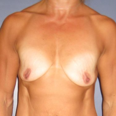 Breast Lift Before Patient 17