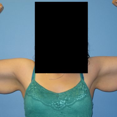 Brachioplasty Before Patient 1