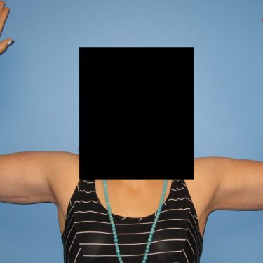 Brachioplasty After Patient 1