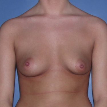 Dual-plane technique Before Patient 6