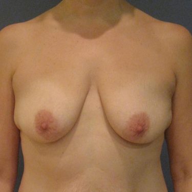 Breast Lift Before Patient 18