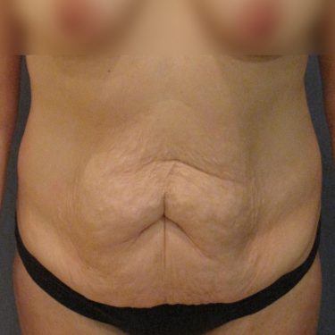 Tummy Tuck Before Patient 19