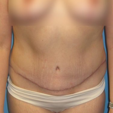 Tummy Tuck After Patient 19