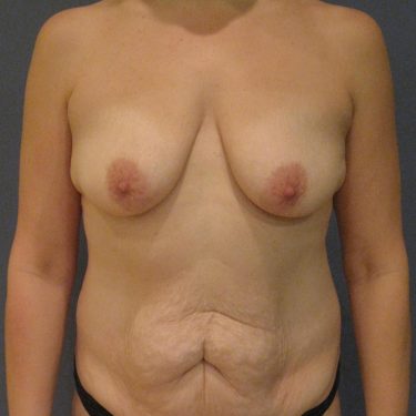 Surgery After Weight Loss Before Patient 6